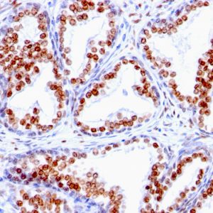Formalin-fixed, paraffin-embedded human Prostate Carcinoma stained with Androgen Receptor monoclonal Antibody (SPM335).