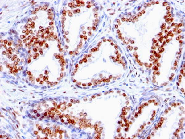 Formalin-fixed, paraffin-embedded human Prostate Carcinoma stained with Androgen Receptor monoclonal Antibody (SPM335).