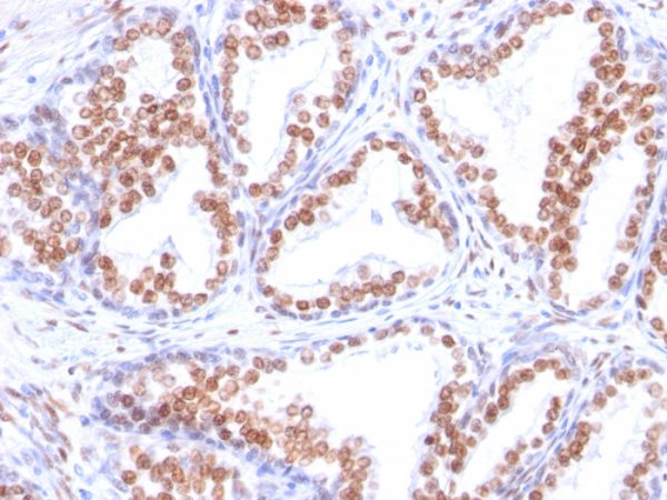 Formalin-fixed, paraffin-embedded human prostate carcinoma stained with Androgen Receptor Mouse Monoclonal Antibody (DHTR/882).