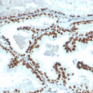 Formalin-fixed, paraffin-embedded human prostate carcinoma stained with Androgen Receptor Recombinant Rabbit Antibody (DHTR/4445R). HIER: Tris/EDTA pH9.0; 95°C/45min. 1 °Ab: 2ug/ml in PBS:30min. 2 °Ab: HRP-Poly:30min. DAB:5min.