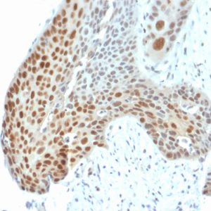 Formalin-fixed, paraffin-embedded human Cervical Tumor stained with Phospho c-Jun Mouse Monoclonal Antibody (C-J 4C4/1).