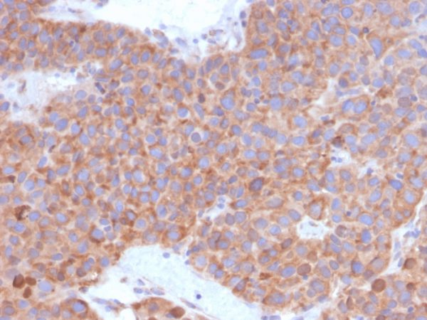 Formalin-fixed, paraffin-embedded human liver carcinoma in colon stained with B7-H6 / NCR3LG1 Mouse Monoclonal Antibody (B7H6/4821).