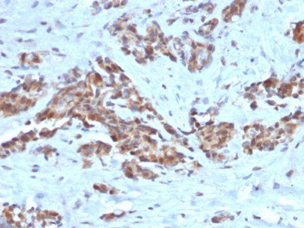 Formalin-fixed, paraffin-embedded human Breast stained with ARF1 Mouse Monoclonal Antibody (ARF1/2117).