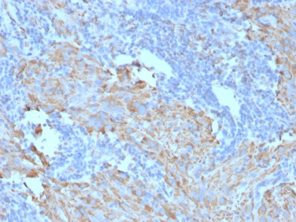 Formalin-fixed, paraffin-embedded human GIST stained with CD117 Mouse Monoclonal Antibody (C117/370).