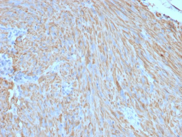 Formalin-fixed, paraffin-embedded human GIST stained with CD117 Mouse Monoclonal Antibody (C117/370).