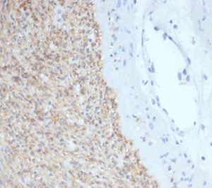 Formalin-fixed, paraffin-embedded human GIST stained with CD117 Mouse Monoclonal Antibody (C117/7119) at 2ug/ml. HIER: Tris/EDTA, pH9.0, 45min. 2 °: HRP-polymer, 30min. DAB, 5min.