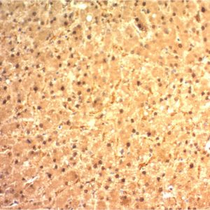 Formalin-fixed, paraffin-embedded human Hepatocellular Carcinoma stained with Arginase-1 Mouse Monoclonal Antibody(ARG1/1125).