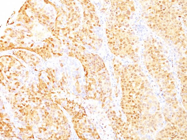 Formalin-paraffin human Hepatocellular Carcinoma stained with ARG1 Mouse Monoclonal Antibody (ARG1/1125 + ARG1/1126).