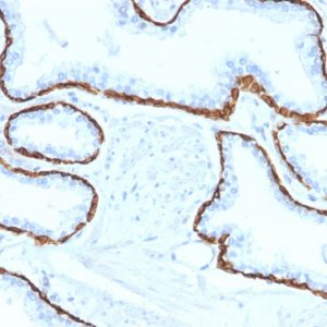 Formalin-fixed, paraffin-embedded human Prostate Carcinoma stained with Cytokeratin 5 (KRT5) Mouse Monoclonal Antibody (KRT5/2080).