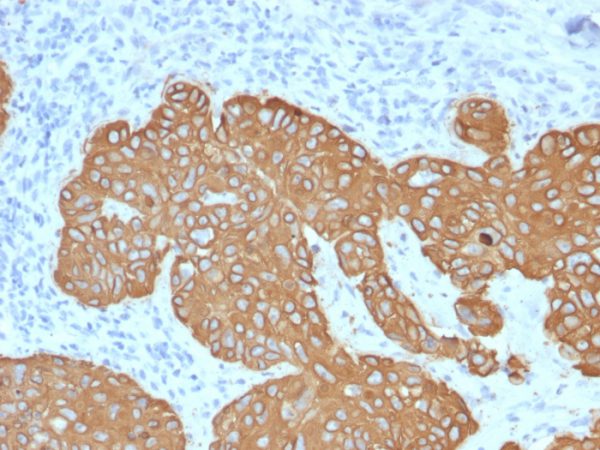 Formalin-fixed, paraffin-embedded human Basal Cell Carcinoma stained with Cytokeratin 5 (KRT5) Mouse Monoclonal Antibody (KRT5/2080).