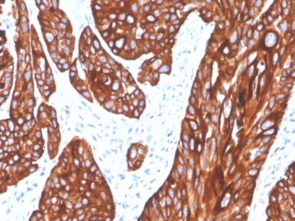 Formalin-fixed, paraffin-embedded human squamous cell carcinoma stained with Cytokeratin 5 Recombinant Mouse Monoclonal Antibody (rKRT5/6398).