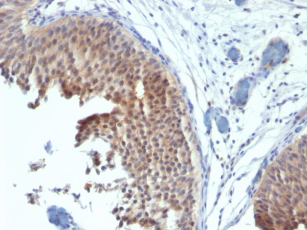 Formalin-fixed, paraffin-embedded human Bladder Carcinoma stained with Cytokeratin 6 Mouse Monoclonal Antibody (SPM269).