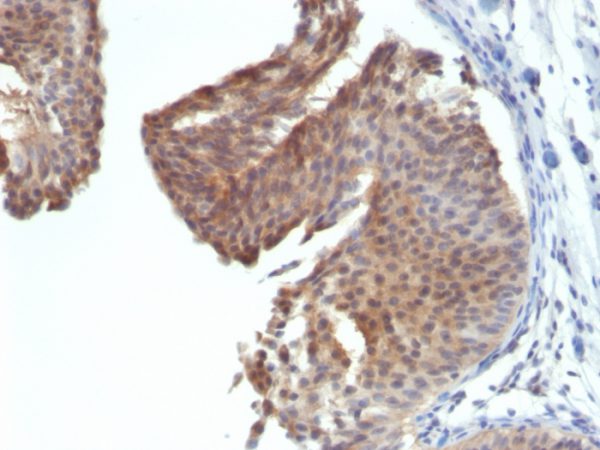 Formalin-fixed, paraffin-embedded human Bladder Carcinoma stained with Cytokeratin 6 Monoclonal Antibody (KRT6/1702)