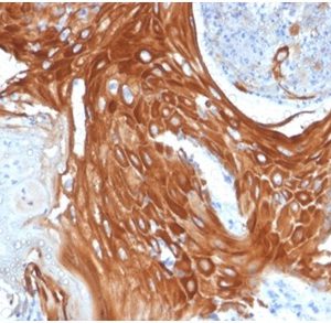 Formalin-fixed, paraffin-embedded human basal cell carcinoma stained with Cytokeratin 6A (KRT6A) Mouse Monoclonal Antibody (KRT6A/2368).