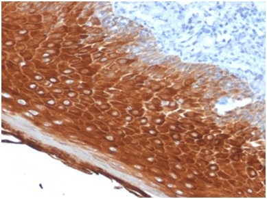 Formalin-fixed, paraffin-embedded human basal cell carcinomastained with Cytokeratin 6A (KRT6A) Mouse Monoclonal Antibody (KRT6A/2368).