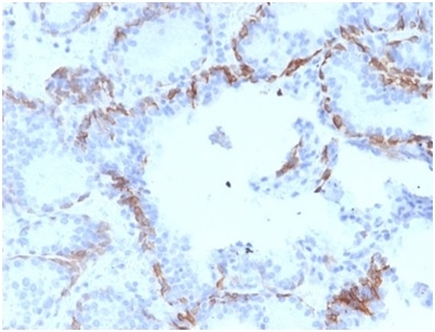 Formalin-fixed, paraffin-embedded human prostate carcinoma stained with Cytokeratin 6A (KRT6A) Mouse Monoclonal Antibody (KRT6A/2368).