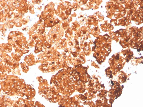 Formalin-fixed, paraffin-embedded human pancreas stained with KRT6A Recombinant Mouse Monoclonal Antibody (rKRT6A/2100).