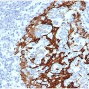 Formalin-fixed, paraffin-embedded human prostatestained with Cytokeratin 6A Recombinant Rabbit Monoclonal Antibody (KRT6/3997R). HIER: Tris/EDTA, pH9.0, 45min. 2 °: HRP-polymer, 30min. DAB, 5min.