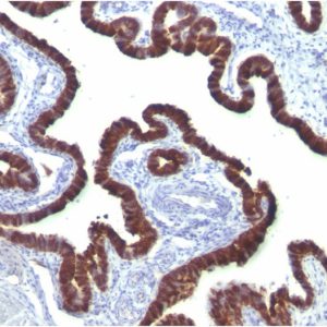 Formalin-fixed, paraffin-embedded human Ovarian Carcinoma stained with Cytokeratin 7 Mouse Monoclonal Antibody (OV-TL12/30)