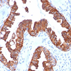 Formalin-fixed, paraffin-embedded human endometrial carcinoma stained with CK7 Recombinant Mouse Monoclonal Antibody (rOV-TL12/30).