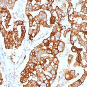 Formalin-fixed, paraffin-embedded human Ovarian Carcinoma stained with Cytokeratin-7 Mouse Monoclonal Antibody (KRT7/2200).