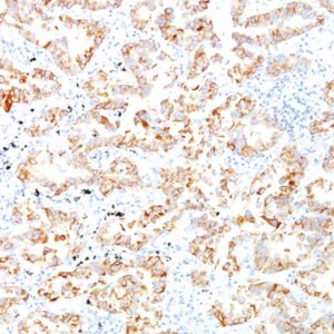 Formalin-fixed, paraffin-embedded human Lung SCC stained with Cytokeratin 7 Monoclonal Antibody (SPM270).