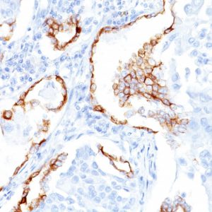 Formalin-fixed, paraffin-embedded human Lung SCC stained with Cytokeratin 7 Mouse Monoclonal Antibody (K72.7).