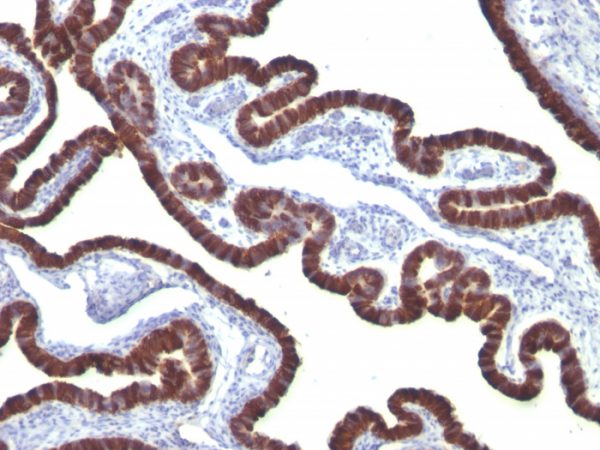 Formalin-fixed, paraffin-embedded human Ovarian Carcinoma stained with Cytokeratin 7 Mouse Monoclonal Antibody (KRT7/760).