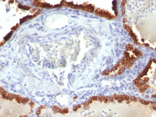 Formalin-fixed, paraffin-embedded human Lung Carcinoma stained with Cytokeratin 7 Mouse Monoclonal Antibody (KRT7/760).