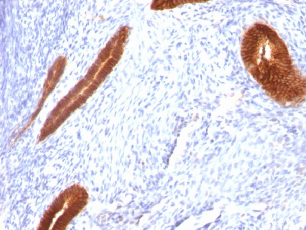 Formalin-fixed, paraffin-embedded human Endometrial Carcinoma stained with Cytokeratin 7 Mouse Monoclonal Antibody (KRT7/760).