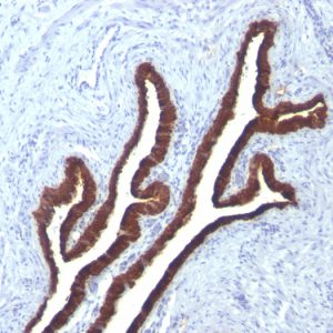 Formalin-fixed, paraffin-embedded human Ovarian Ca stained with Cytokeratin 7 Mouse Monoclonal Antibody (KRT7/760 + KRT7/903).