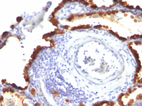 Formalin-fixed, paraffin-embedded human Lung Ca stained with Cytokeratin 7 Mouse Monoclonal Antibody (KRT7/760 + KRT7/903).