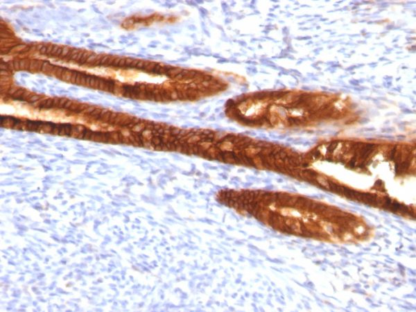 Formalin-fixed, paraffin-embedded human Endometrial Ca stained with Cytokeratin 7 Mouse Monoclonal Antibody (KRT7/760 + KRT7/903).