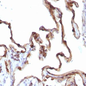 Formalin-fixed, paraffin-embedded human Lung Carcinoma stained with Cytokeratin 7 Mouse Monoclonal Antibody (KRT7/1198).