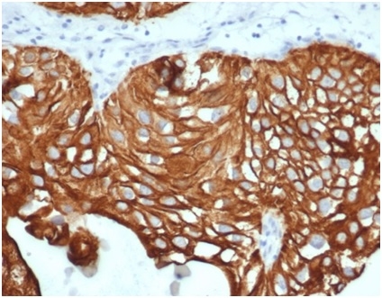 Formalin-fixed, paraffin-embeddedhuman bladdercarcinoma stained with Cytokeratin 7 Recombinant Rabbit Monoclonal Antibody (KRT7/4387R).
