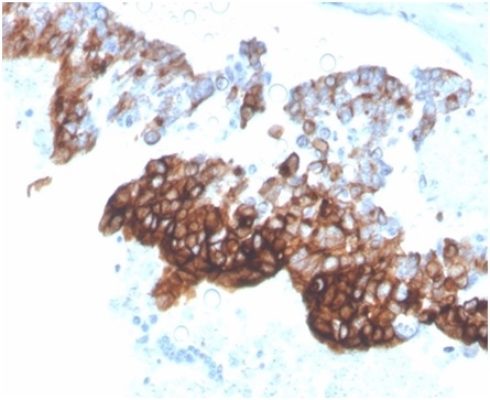 Formalin-fixed, paraffin-embedded human ovarian carcinoma stained with Cytokeratin 7 Recombinant Rabbit Monoclonal Antibody (KRT7/4387R).