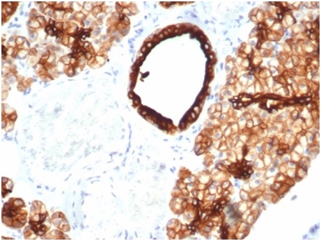 Formalin-fixed, paraffin-embedded human ovarian carcinoma stained with Cytokeratin 7 Recombinant Rabbit Monoclonal Antibody (KRT7/4387R).