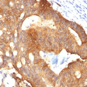 Formalin-fixed, paraffin-embedded Colon Carcinoma stained with Cytokeratin 8 Mouse Monoclonal Antibody (B22.1).