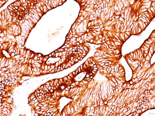 Formalin-fixed, paraffin-embedded human Colon Carcinoma stained with Cytokeratin 8 Mouse Monoclonal Antibody (TS1).