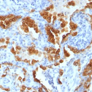 Formalin-fixed, paraffin-embedded human Lung Carcinoma stained with Cytokeratin 8 Mouse Monoclonal Antibody (H1+TS1)