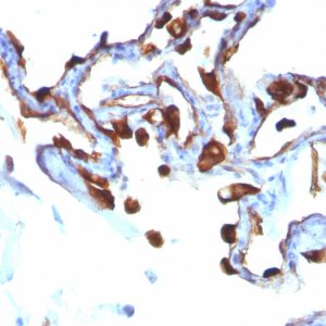 Formalin-fixed, paraffin-embedded human Lung Carcinoma stained with Cytokeratin 8 Mouse Monoclonal Antibody (KRT8/803).