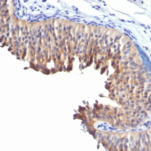 Formalin-fixed, paraffin-embedded human Bladder Carcinoma stained with Cytokeratin 10 Mouse Monoclonal Antibody (LH2).