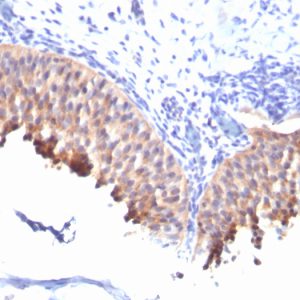 Formalin-fixed, paraffin-embedded human Bladder Carcinoma stained with Cytokeratin 10 Mouse Monoclonal Antibody (SPM261).