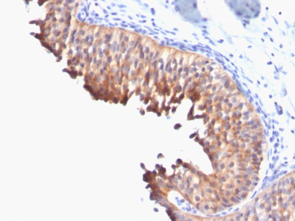 Formalin-fixed, paraffin-embedded human Bladder Carcinoma stained with Cytokeratin 10 Monoclonal Antibody (DE-K10).
