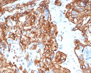 Formalin-fixed, paraffin-embedded human lung carcinoma stained with Cytokeratin 14 Mouse Monoclonal Antibody (KRT14/6957). HIER: Tris/EDTA, pH9.0, 45min. 2 °: HRP-polymer, 30min. DAB, 5min.