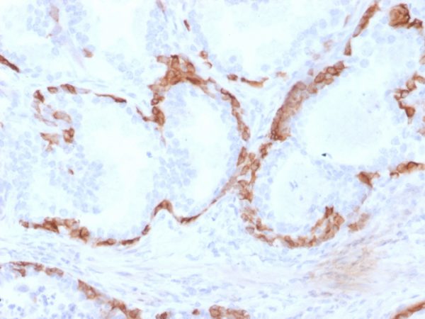 Formalin-fixed, paraffin-embedded human Prostate Carcinoma stained with Cytokeratin 14 Mouse Monoclonal Antibody (KRT14/2375).