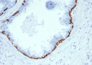 Formalin-fixed, paraffin-embedded human prostate stained with Cytokeratin 14 Recombinant Rabbit Monoclonal Antibody (KRT14/4584R). HIER: Tris/EDTA, pH9.0, 45min. 2 °: HRP-polymer, 30min. DAB, 5min.