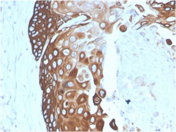 Formalin-fixed, paraffin-embedded human Basal Cell Carcinoma stained with Cytokeratin 15 Mouse Monoclonal Antibody (SPM190).