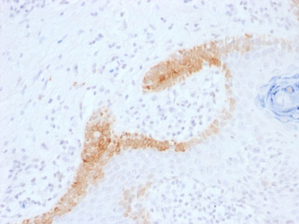 Formalin-fixed, paraffin-embedded human Basal Cell Carcinoma stained with Cytokeratin 15 Mouse Monoclonal Antibody (KRT15/1699).
