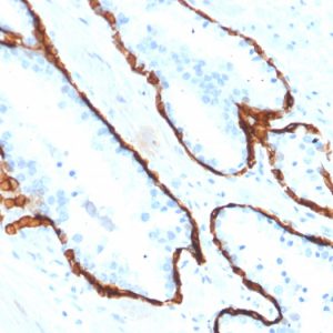 Formalin-fixed, paraffin-embedded human Prostate Carcinoma stained with Cytokeratin 15 Mouse Monoclonal Antibody (KRT15/2554).